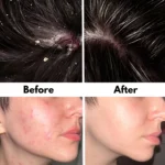 tea-tree-oil-dandruff-acne-before-and-after